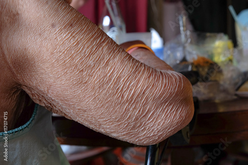  old women skin - wither arm photo