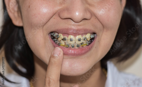 Diamond braces for teeth