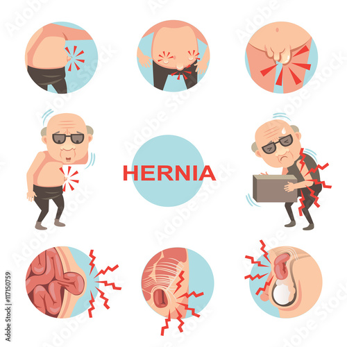 Hernia/Diagram of inside  umbilical and inguinal hernia, Men with hernia symptoms and signs that can be noticed.Cartoon vector illustration