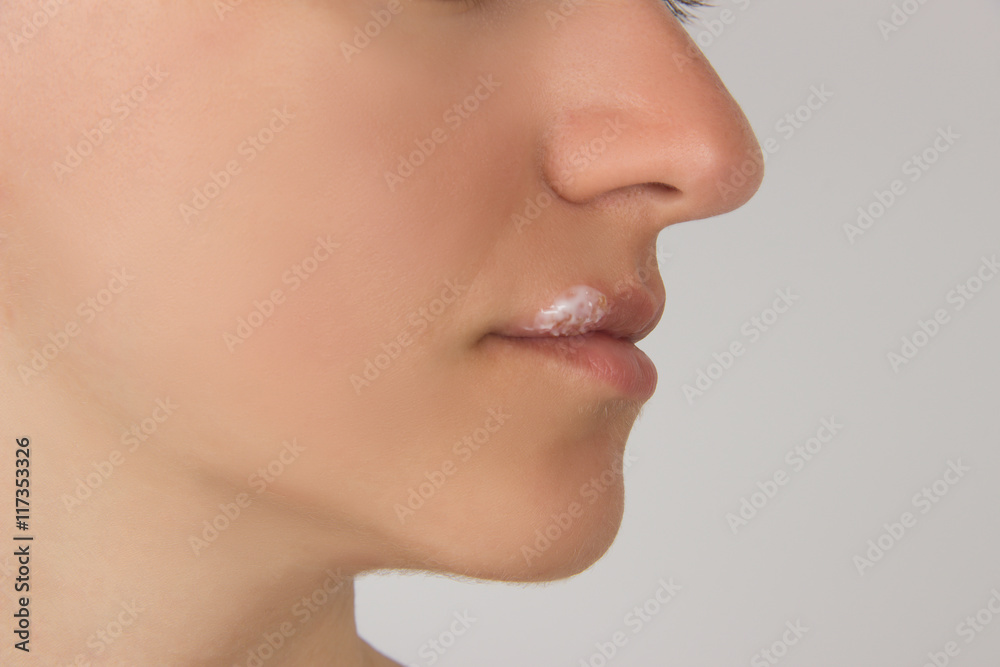 Obraz premium Herpes sore with pus on the lips of the young beautiful girl and