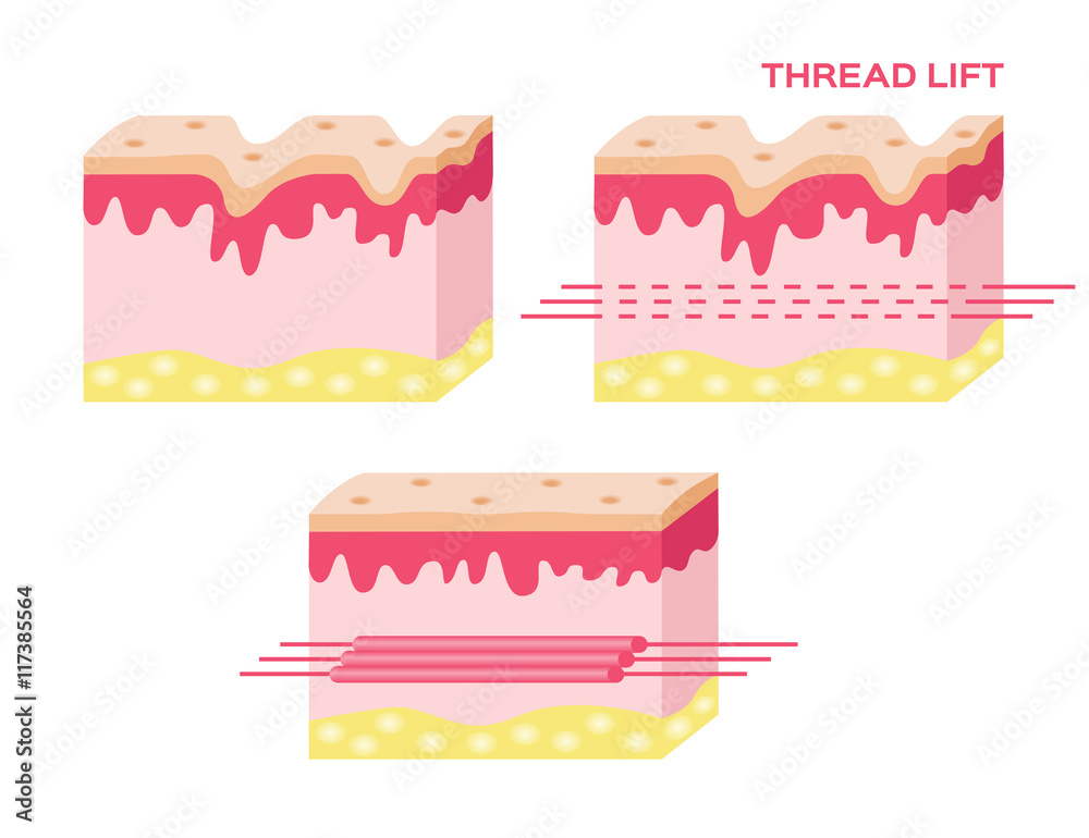 skin vector with step of thread lift , thread lift vector skin vector with step of thread lift , thread lift vector