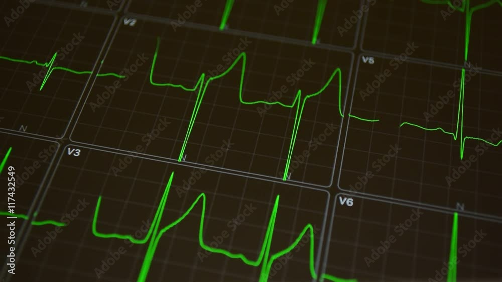 Heart attack cardiogram. Heart beat ECG monitor. Heart attack cardiogram. Heart beat ECG monitor.