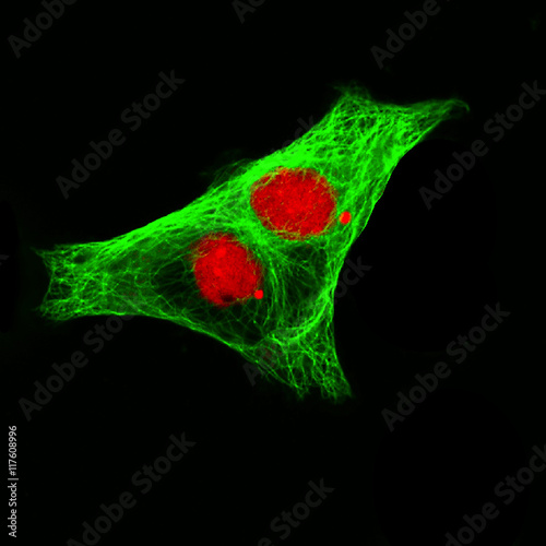 Real fluorescence microscopic view of human neuroblastoma cells