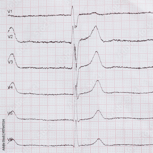 Cardiogram on paper. Shows heart rate.