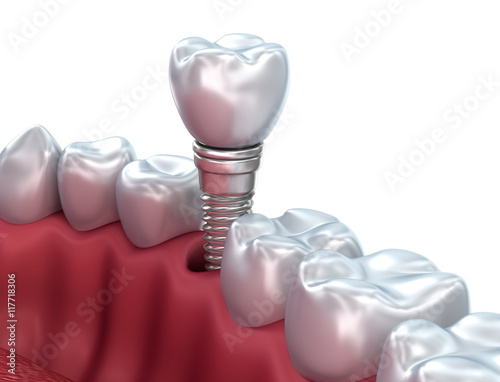 Dental implant, Medically accurate 3D illustration