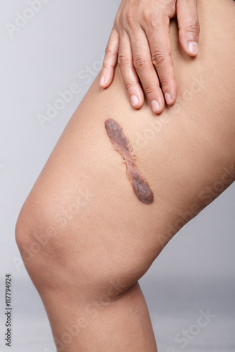 Scar on human skin