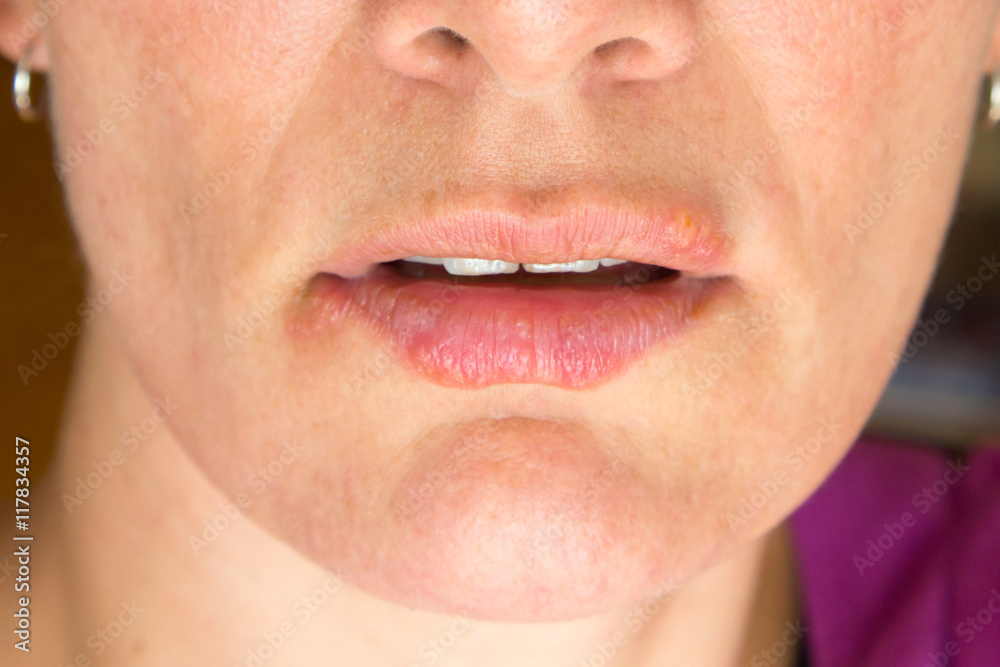 Lippenherpes Lippenherpes