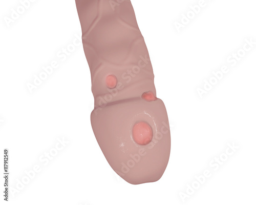 Syphilitic ulcer ulcus durum on the surface of a penis, 3D illustration photo