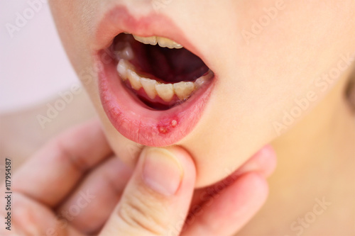 Stomatitis on lip in child  photo