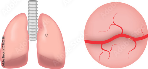 Pulmonary Embolism (PE)