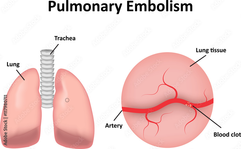 Fototapeta premium Pulmonary Embolism labeled Diagram