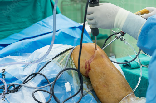 arthroscope surgery
