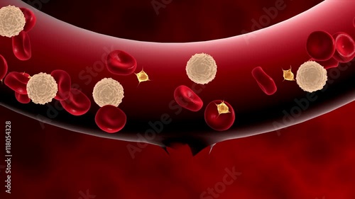Blood clotting inside artery.