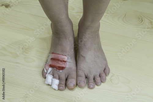 scar on foot of Asian women by dog bite injury on wooden background ..