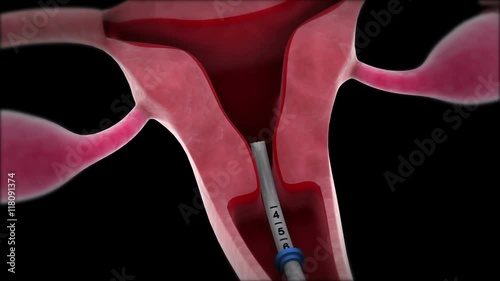 Insertion of an intrauterine device into the uterus. photo