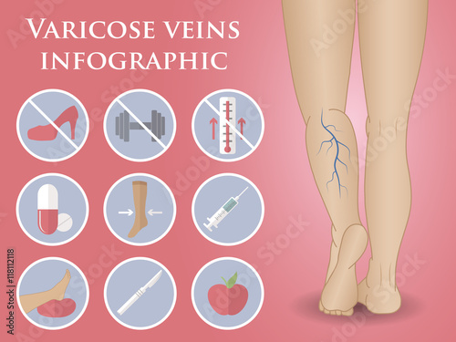 phlebology vector infographic