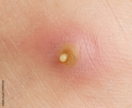 Fotografia boil on the skin