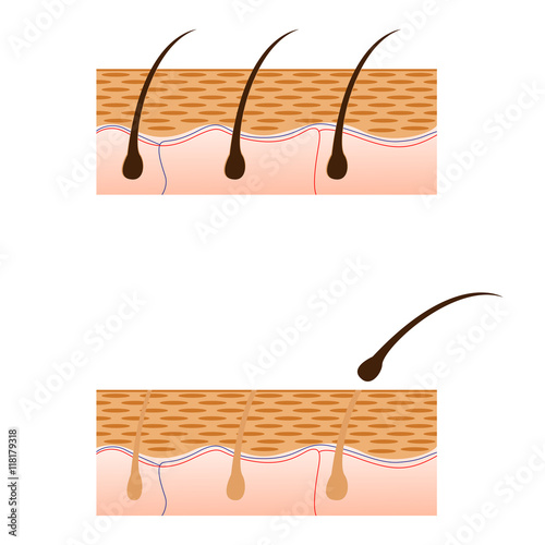 Epilation and skin with hair sectional view.