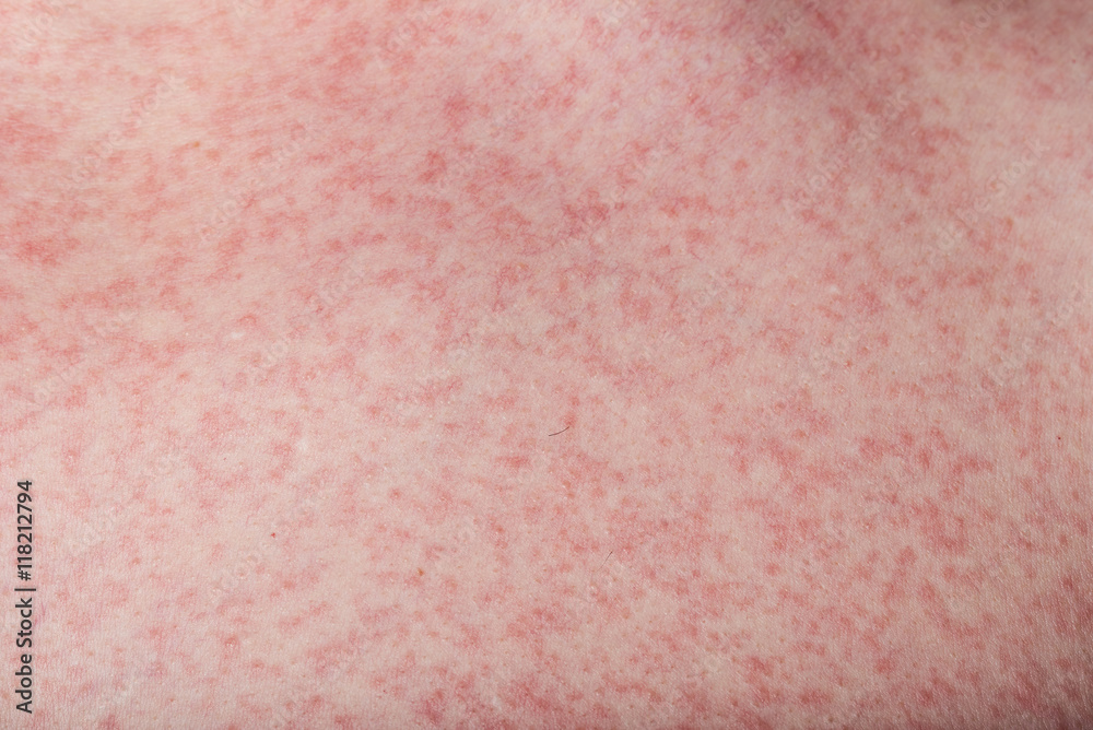 macro of skin with rash