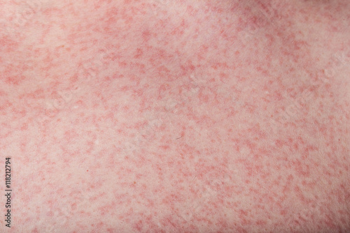 macro of skin with rash photo