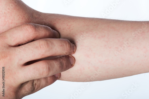 close up of hand with rash photo