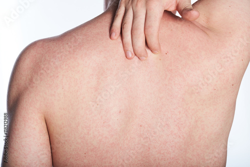allergy on back of man