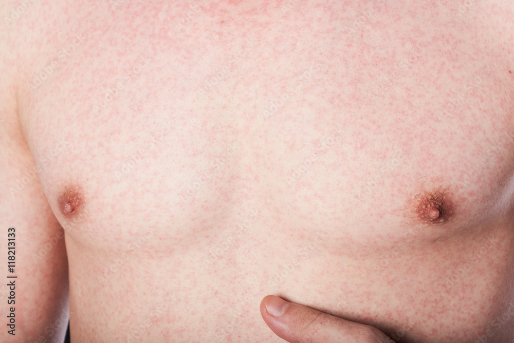 rash on man chest rash on man chest