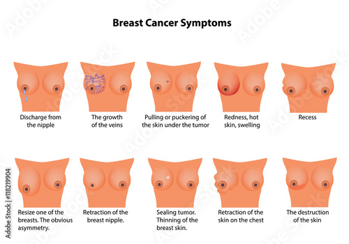 Symptoms of breast cancer. Infographics. Vector illustration on isolated background
