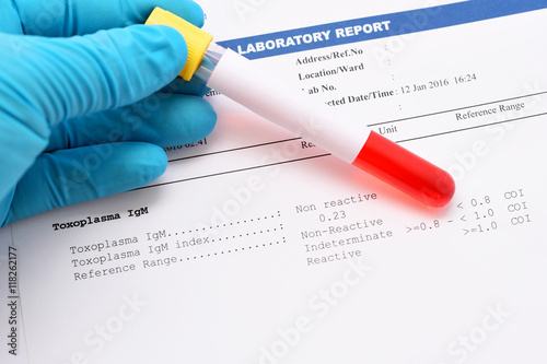 Toxoplasma testing result
 photo