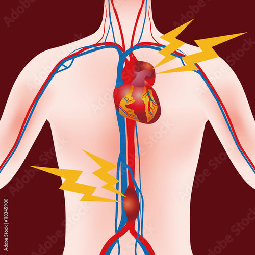 Abdominal Aortic Aneurysm and Thoracic Aortic Aneurysm, human anatomical chart