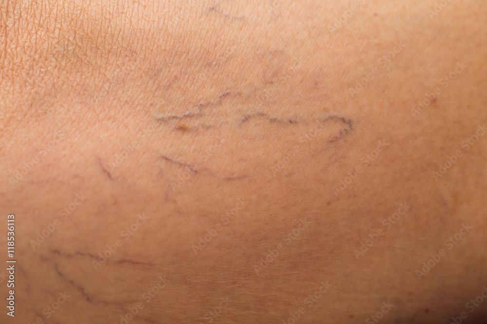 Fototapeta premium Pajączki naczyniowe na nodze. Teleangiektazja. 