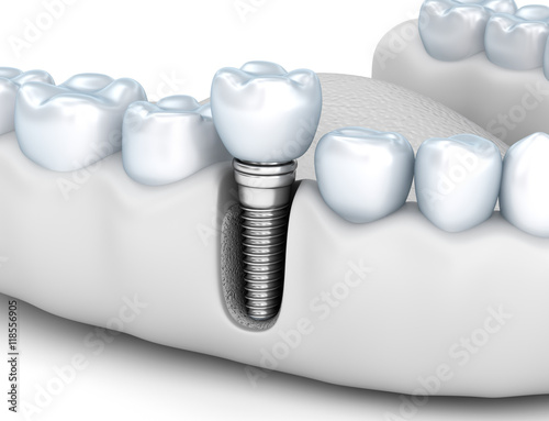 Fototapeta Naklejka Na Ścianę i Meble -  Tooth human implant, Medically accurate 3D illustration white style