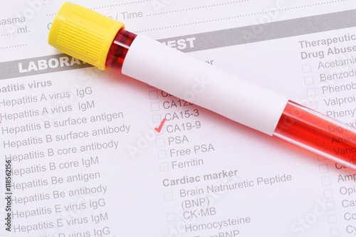 Blood sample for CA 19-9 test, pancreatic cancer diagnosis