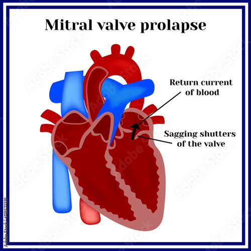 Heart structure. Mitral valve prolapse. Cardiac pathology.