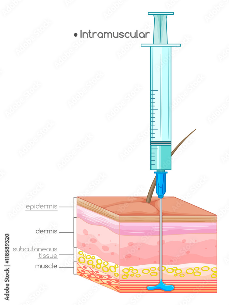 Intramuscular Injection Diagram