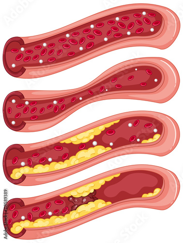 Diagram showing blood clot in human veins