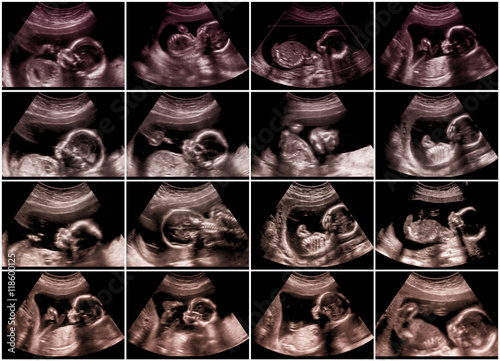 Collage of 16 ultrasonography fetus pictures photo