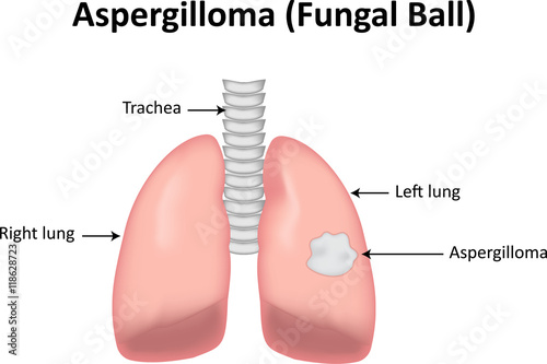 Aspergilloma