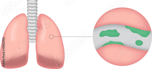 Bronchiectasis 