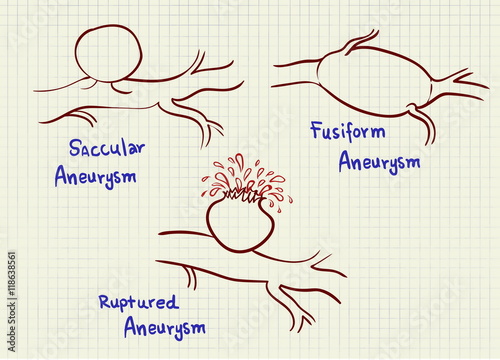 aneurysm vector graphic scheme