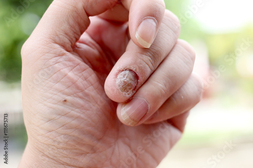 Canvastavla Fungus Infection on Nails Hand, Finger with onychomycosis, A toenail fungus