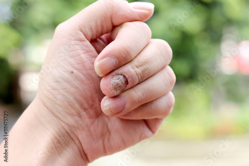 Canvastavla Fungus Infection on Nails Hand, Finger with onychomycosis, A toenail fungus