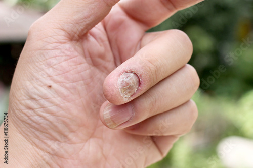 Konstfotografi Fungus Infection on Nails Hand, Finger with onychomycosis, A toenail fungus