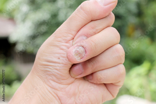Fungus Infection on Nails Hand, Finger with onychomycosis, A toenail fungus. - soft focus © narin_nonthamand