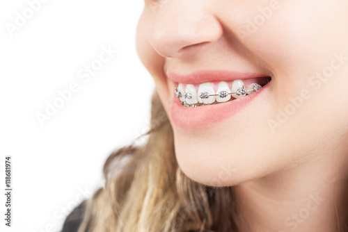 Teeth with Braces