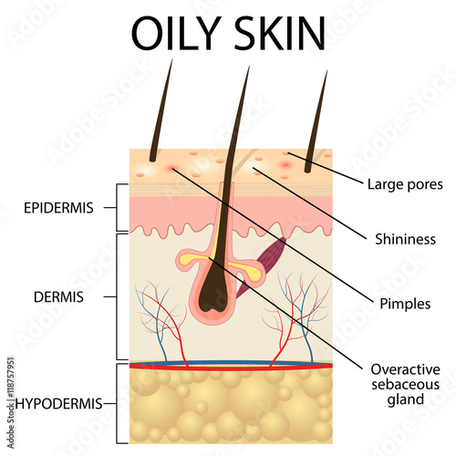 Illustration of The layers of oily skin