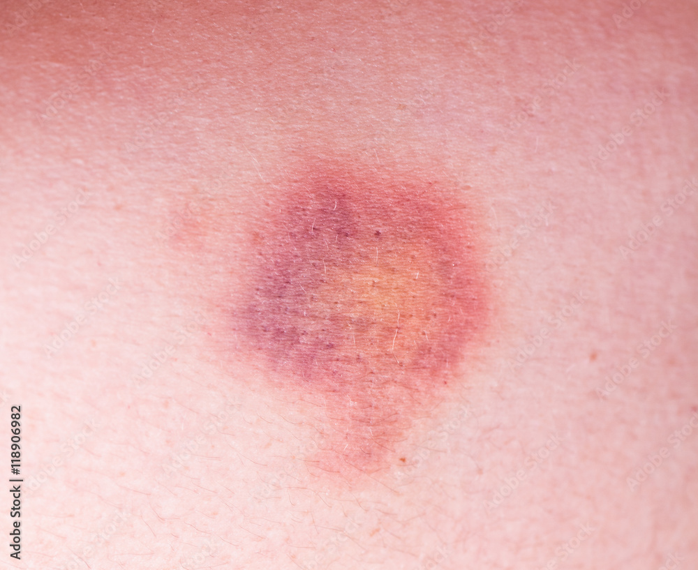 Closeup on a Bruise on wounded Closeup on a Bruise on wounded