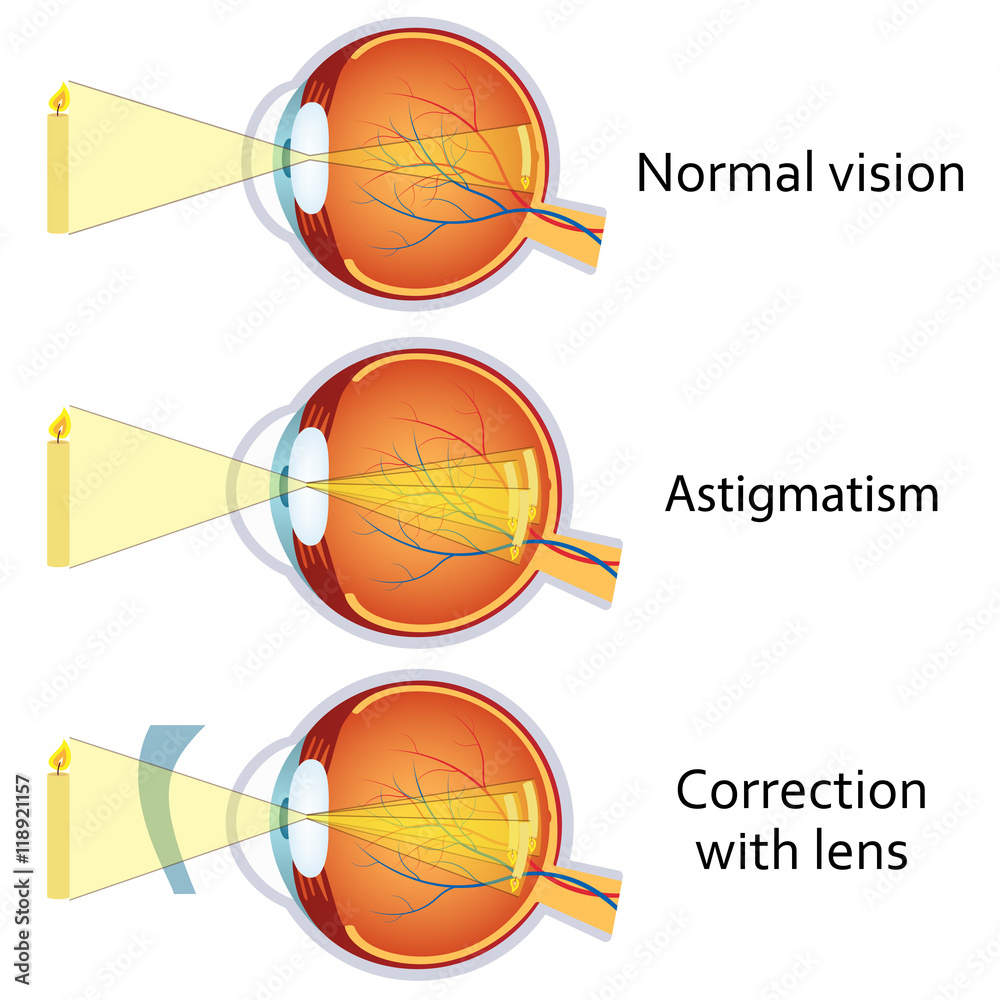 Astigmatism corrected by a cylindrical lens.