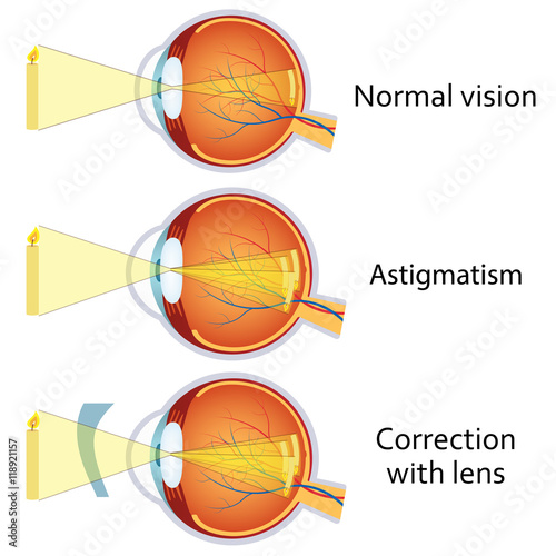 Astigmatism corrected by a cylindrical lens. © Neokryuger