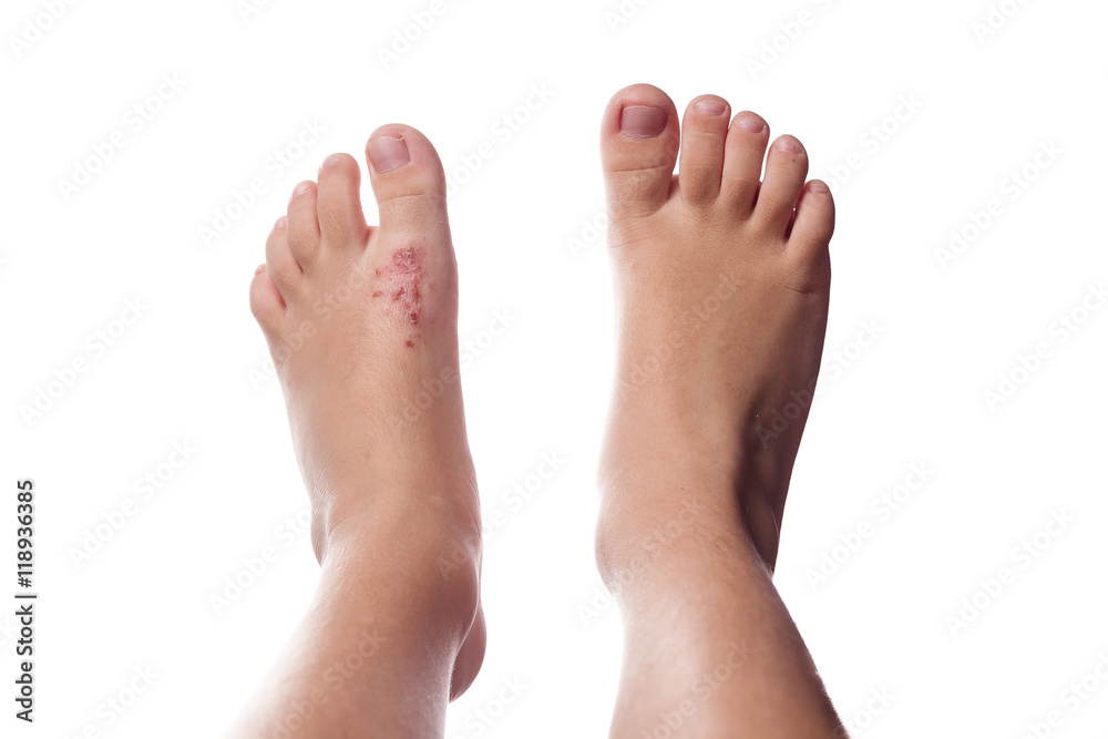 Eczema, atopic dermatitis. Close up of eczema on the skin of the Eczema, atopic dermatitis. Close up of eczema on the skin of the